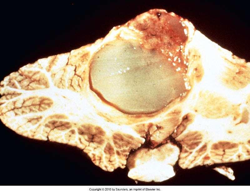 Tumörer allmänt Tumör: Okontrollerade proliferation av transformerade kroppsegna celler (-om) Benign: Expansiv, förträngande växt Malign: Infiltrativ, förstörande växt och förmåga att metastaserar