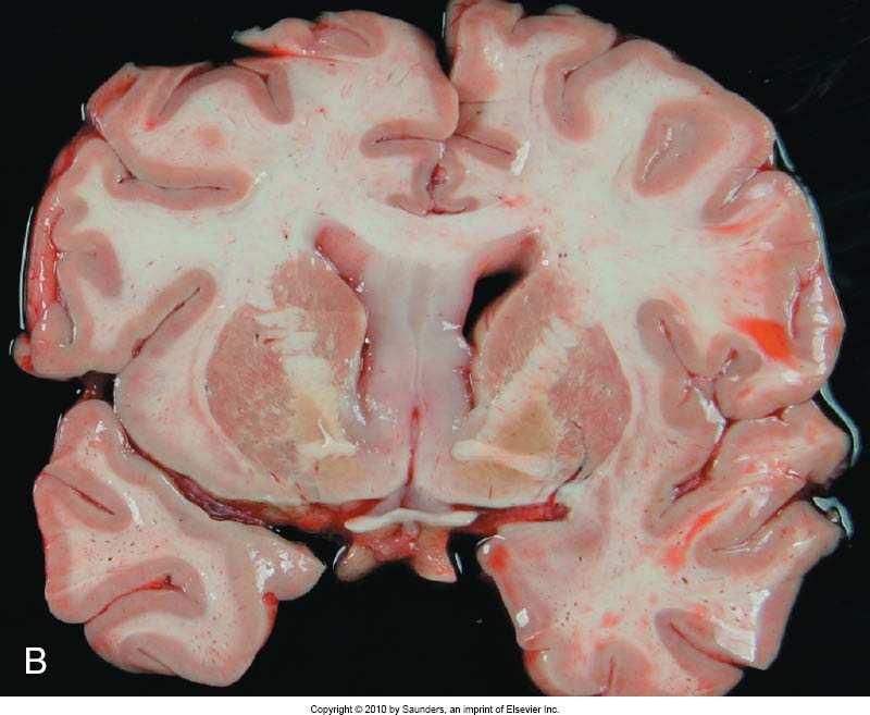 Glioma: Bilder Astrocytom, intermediär malignitet: Mer diffus.