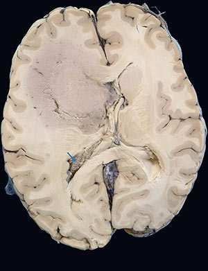 hjärnhinnan Metastaser Tumörer i perifera nervsystemet Lymfom i hjärnan Tumör