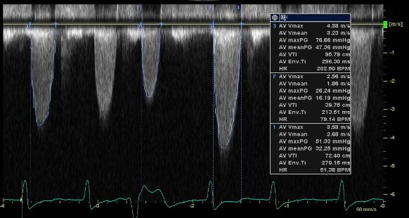 Gradienten är flödesberoende P 32 mmhg, efter längre RR intervall 47 mmhg