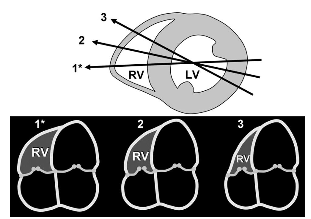 Mätning av trikuspidal annulus Rudski LG et al.