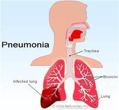 Differentialdiagnos gentemot akut bronkit Pneumoni Symtom: feber, hosta, dyspné, nytillkommen uttalad trötthet och andningskorrelerad bröstsmärta.