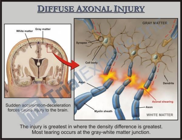 Diffus axonal skada innebär skjuvning och sträckning av nervceller på cellnivå.