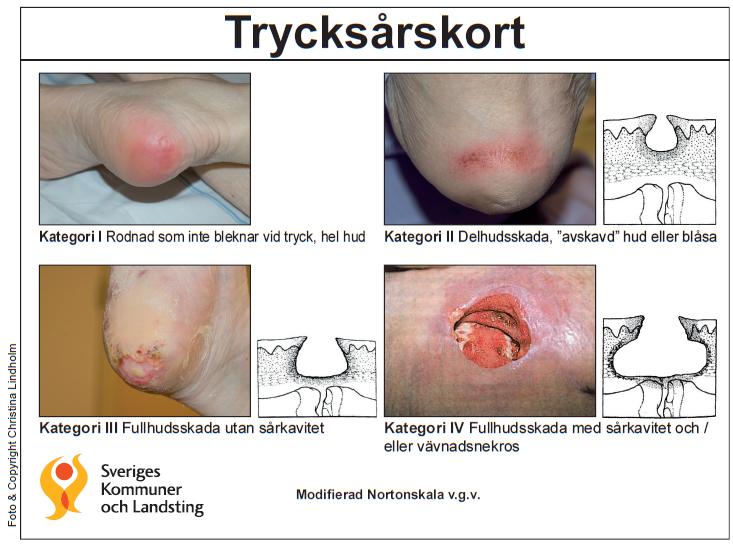 Rapport 11(11) Dokumentnamn: Punktprevalensmätning trycksår