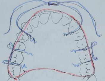 Indikationer: postnormala bett med nätt vertikal överbitning Syfte: molarextrusion förhindras genom att akrylatet behålls mellan tandraderna. EOD minskar maxillans framåtriktade växt.