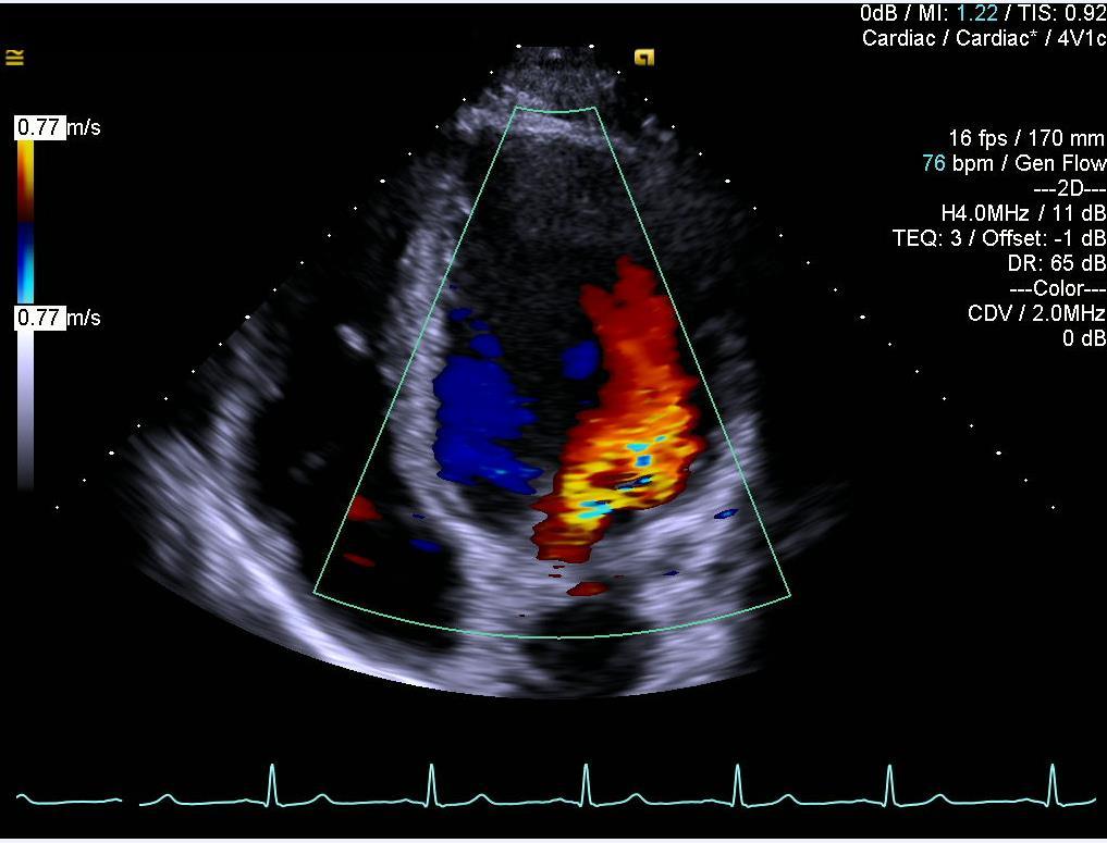 Del 3 Linköpings universitet Vilo-EKG visar kammarfrekvens 58 slag/minut med PQ-tid 140 ms, QRS-duration 106 ms, QT/QTc 428/420 ms.