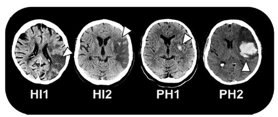 Riskfaktorer för hemorrhagisk omvandling Infarktvolym Svårighetsgrad Ålder Tid till rekanalisation Kardioembolisk (ffa vid klaff/endokardit) Radiologiska fynd (tidiga infarkttecken, leukoaraios,