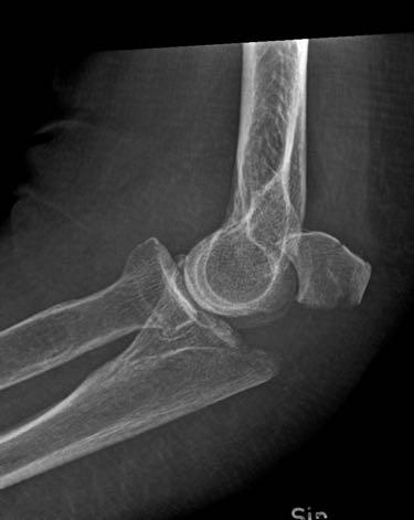 Olecranonfraktur Distal