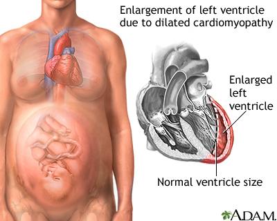 Management of stable heart failure in peripartum cardiomyopathy After delivery, PPCM should be treated in accordance with the current ESC