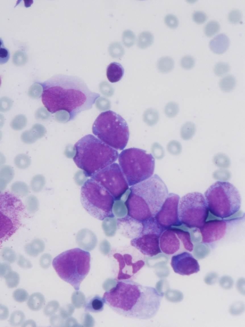 AML med t(8;21) Blastandel kan vara <20% 5% av alla AML Ofta M2 morfologi, Auerstavar även i granulocyter Stora blaster med basofil cytoplasma