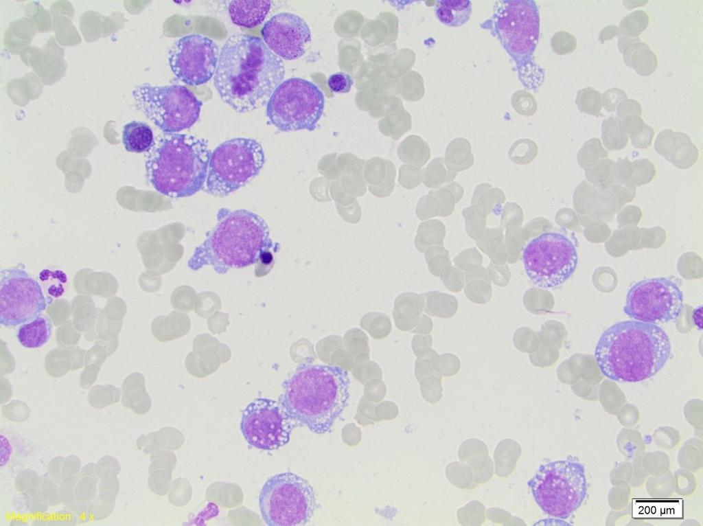 Akut monoblastisk och akut monocytisk leukemi <5% av AML 80% monocytär differentiering monoblaster, promonocyter och