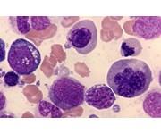 Akut erytroid leukemi Pure erythroid leukemia Saknar vanligtvis Myeloiska