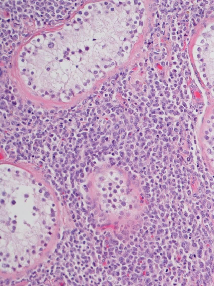 Myelosarkom (klorom, granulocytisk sarkom) Tumör bestående av myeloiska blaster utan/med utmognad som växer utanför BM.