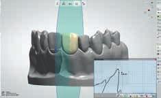 5 mm, IPS e.max CAD HT B1); höger: krona (1.5 mm, IPS e.max CAD LT B1) Cement: Variolink Esthetic neutral Preparationsfärg: IPS Natural Die Material, ND 6 5 Skriv in materialet ( IPS e.