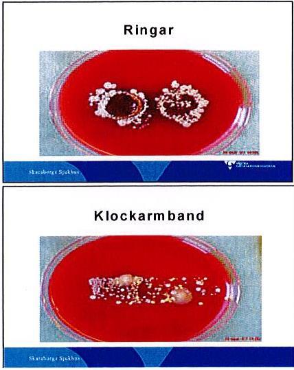 Bakterietillväxt på två ringar som har tryckts mot en odlingsplatta strax efter handdesinfektion.