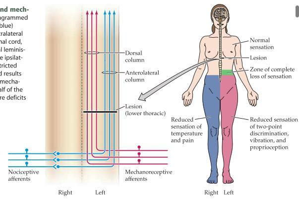 neuron i dorsal column nuclei. Axonerna av neuronerna i dorsal column nuclei korsar därefter mittenlinjen i kaudala medulla och tar sig till den kontralaterala thalamus.