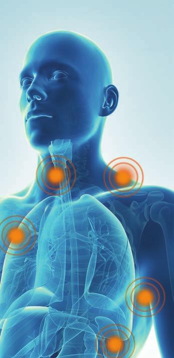 Jämfört med OPDIVO monoterapi har en ökning av PFS och OS med kombinationen nivolumab och ipilimumab endast visats hos patienter med lågt tumöruttryck av PD-L1.