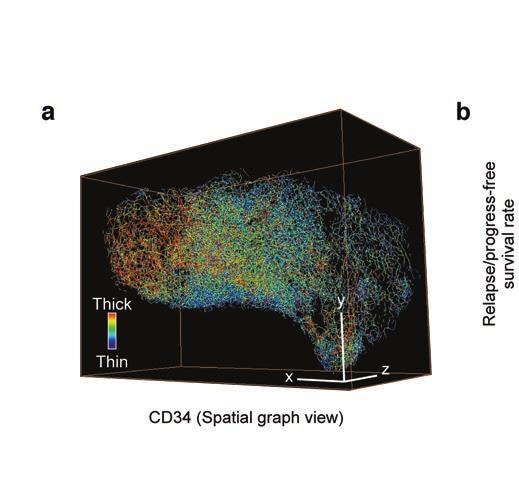 diagnostik Figur 3. (a) Volym-rendering av 3D-mikroskopi-data från äggstockscancer med platinum-resistens. Blodkärlen är infärgade med en antikropp mot CD34.