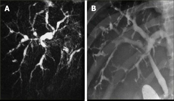 MRCP-bild