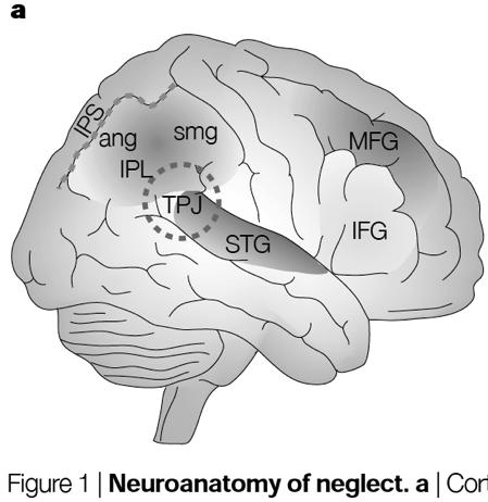 Visuospatial neglect After a stroke: 20-23% After a right hemisphere stroke: 32-44% After a left hemisphere stroke: 8-20% Samuelsson, H, Hjelmquist, EKE, et al.