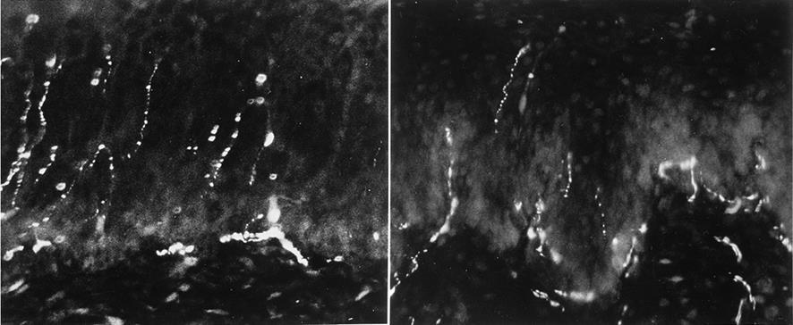 Ökad mängd intraepiteliala C-fibrer Immunohistokemi och neurokemisk analys vid vestibulodyni Ökat antal intraepiteliala nerver i vestibulumslemhinnan vid vestibulodyni Nerverna immunopositiva för SP