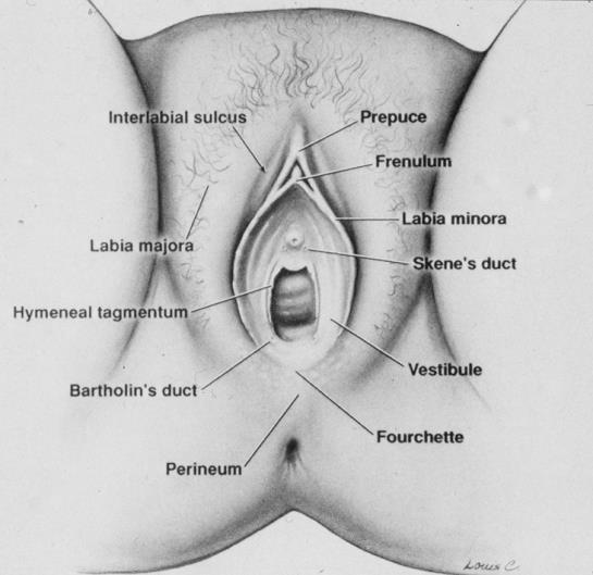 Vulvodyni- ISSVD 2015 A Vulva smärta relaterad till ett specifikt tillstånd 1. Infektioner (recidiverande candida, herpes) 2. Inflammatoriska (dermatoser) 3.