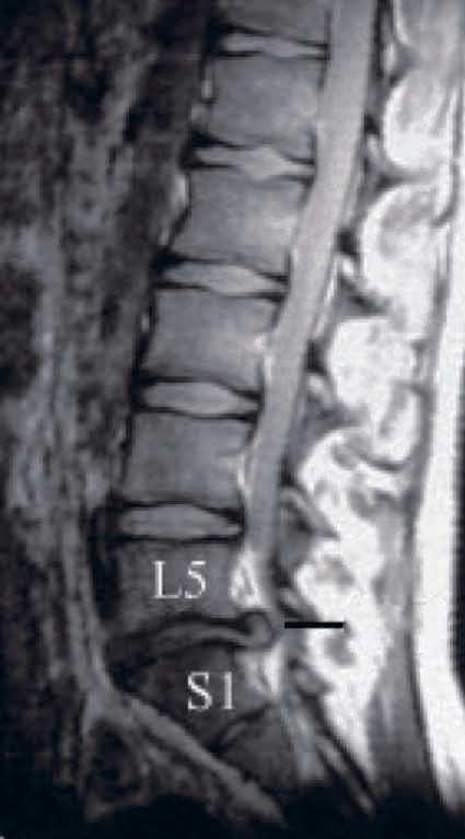 Varför utförs operationen? Diskbråck orsakar besvär om det trycker på nerver och ger inflammation i nervstrukturen (fig.2). Diskbråck Fig. 2 Då får man ritzopathi, d.v.s. smärta som strålar ut i ena eller båda benen.