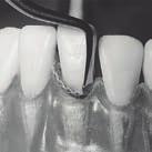 Gingivalrandskärare, 1,2 mm, distal LM 121-122 ES LM 121-122 XSI LM 121-122 SI Gingivalrandskärare, 1,2 mm, mesial LM 125-126 ES LM 125-126 XSI LM 125-126 SI SPATEL Spatel LM 450-460 ES LM