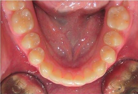 Myofunktionell forskning påvisar en korrelation mellan bettfel och orofacial