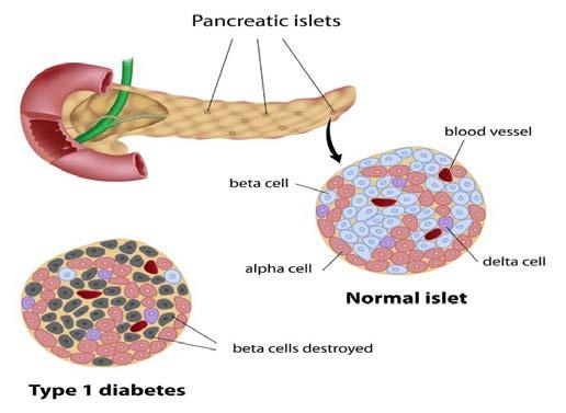 Figur 2. Schematisk bild på celltyper i Langerhans öar och skillnaden mellan normala öar och T1D öar (Agardh, Berne & Östman 2005)