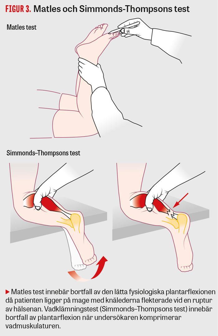 När en bekräftad diagnos av akillesruptur finns erhåller patienten ett gips i spetsfot eller en walkerstövel direkt på akutmottagning.