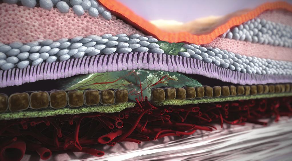 2 Koroidal neovaskularisering innebär tillväxt av nya, försvagade blodkärl under makulan, som kan läcka vätska och blod under näthinnan, vilket påverkar din centrala syn.