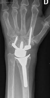 handleden komma ifråga. Beroende på vilka skelettskador som uppstått kan partiell eller komplett steloperation av handleden komma alternativt ifråga.