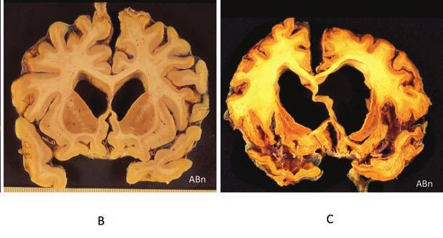 Demens Bild 1. Snitt genom bakre pannloberna vid temporallobsspetsen hos A normal, B måttligt uttalad frontotemporal demen och C vid svår frontotemporal demens.