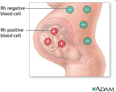 Vad är erytrocytimmunisering? Mor och foster olika med avseende på antigen på de röda blodkropparna.