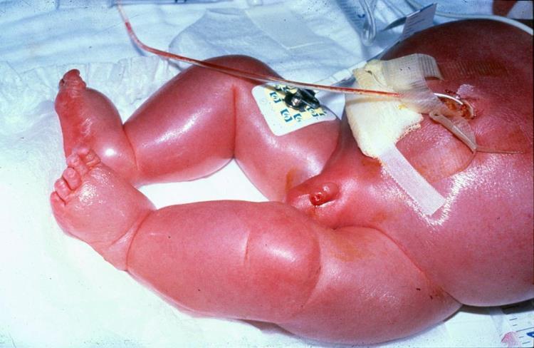 Risker för barnet hemolytisk sjukdom hos foster och nyfödda Hemolytisk anemi