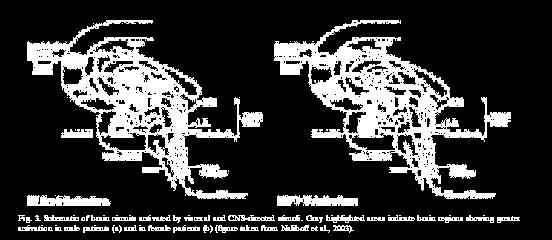 Visceral smärta Ballong distension hos IBS patienter Aktivitet i limbiska strukturer, Naliboff et al. Sex-related differences in IBS patients: central processing of visceral stimuli.