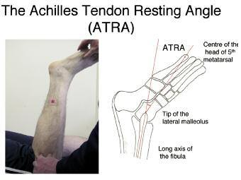 Figur 1. Achilles Tendon Resting Angle (ATRA) gränsningar.