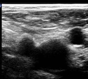 Vid djup venös insufficiens kan man misstänka tidigare genomgången Figur 2 - konfluensen av v femoralis och v profunda femoris DVT, spara loop!