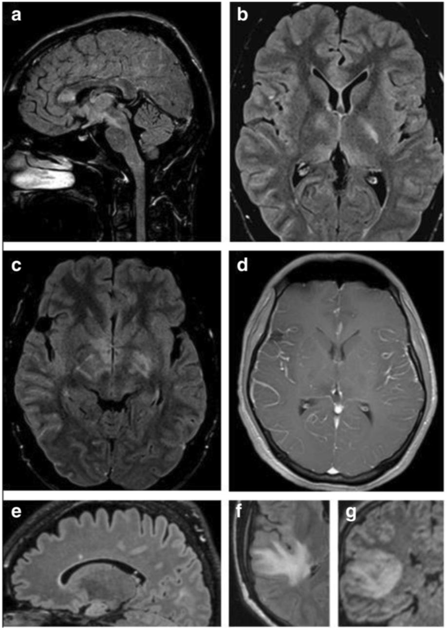 MRI Lesioner i hjärna och hjärnstam