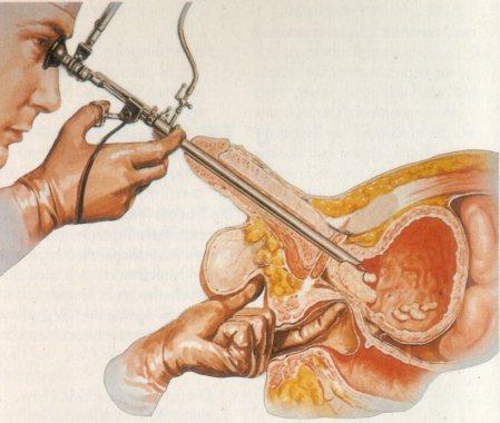 Obstruktion Dynamisk Muskeltonus Statisk Prostata Alfa-blokerare 5 alfareduktas hämmare 12-23 / 3-5 IPSS 12-23 / 3-5 >16s / < 10 ml/s Flöde > 16s / < 10 ml/s Prostata volym > 40 g