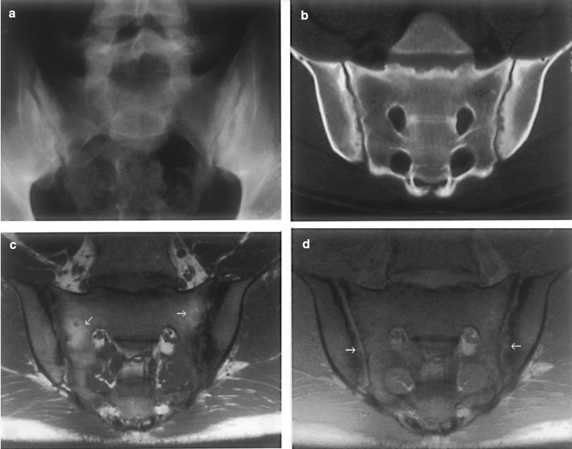 Imaging av axial SpA Röntgen av SI-lederna CT av