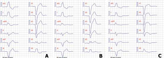 Figur 2. Fallbeskrivning 1. A. EKG före akutbesöket. EKG visar bredd ökade QRS-komplex (> 120 ms), djup och bred S-våg i V1 och bred R-våg i V6, som vid vänstergrenblock. B.