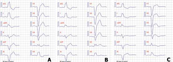 Figur 2. Fallbeskrivning 1. A. EKG före akutbesöket. EKG visar bredd ökade QRS-komplex (> 120 ms), djup och bred S-våg i V1 och bred R-våg i V6, som vid vänstergrenblock. B.