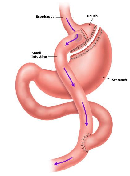 Gastric