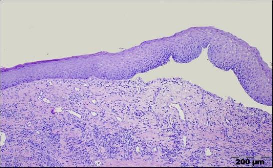 Diagnostik Kliniska differentialdiagnoser: OLP, pemfigus