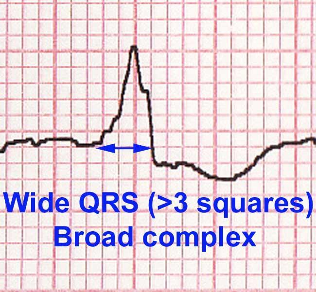 EKG QRS-bredd Normalt <100msek Tilltar/avtar? ORS-bredd toxisk påverkan? Annat?