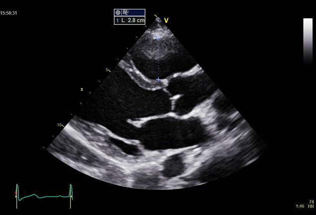 A: SAX: höger kammares utflödesdiameter, RVOT1 (RVOT2 ej