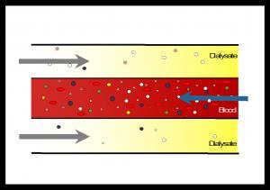 Till patient Från patient Diffusion: hemodialys - II Dialysatpump och därmed dialysatvätskans flödeshastighet