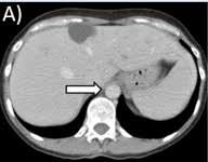 PET-CT FÖRE AORTITEN Figur 3.